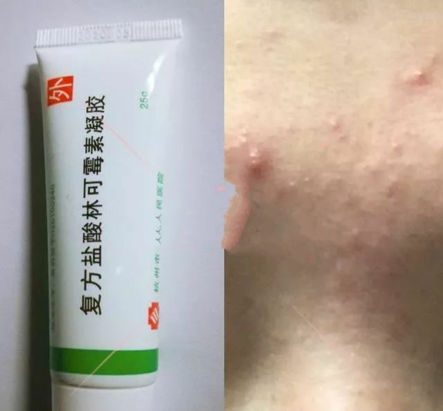 战痘小神器,痘痘肌必备的消痘神器