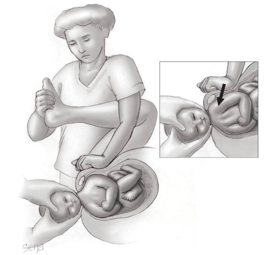 可怜的孩子刚生下来,孕妇医院产子肩膀还卡住了