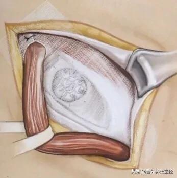 疝气注射疗法是治病还是致病？