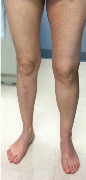 踢球外伤血肿，卧床又生血栓，如何是好？他这么做，远离致命肺梗