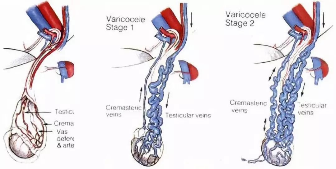 精索静脉曲张引起精子畸形率98%,精索静脉曲张风险多大