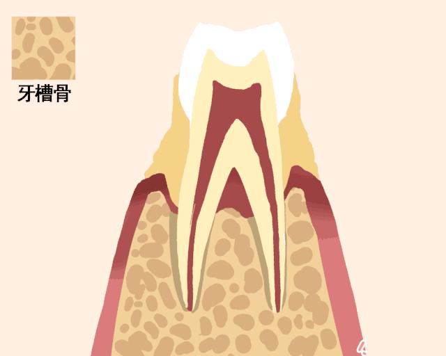 补牙补到牙齿都秃没了,补牙快到牙神经了补完咬合疼