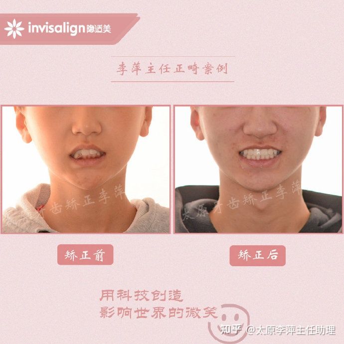 太原牙齿矫正靠谱吗,太原成人隐形牙套牙齿不齐