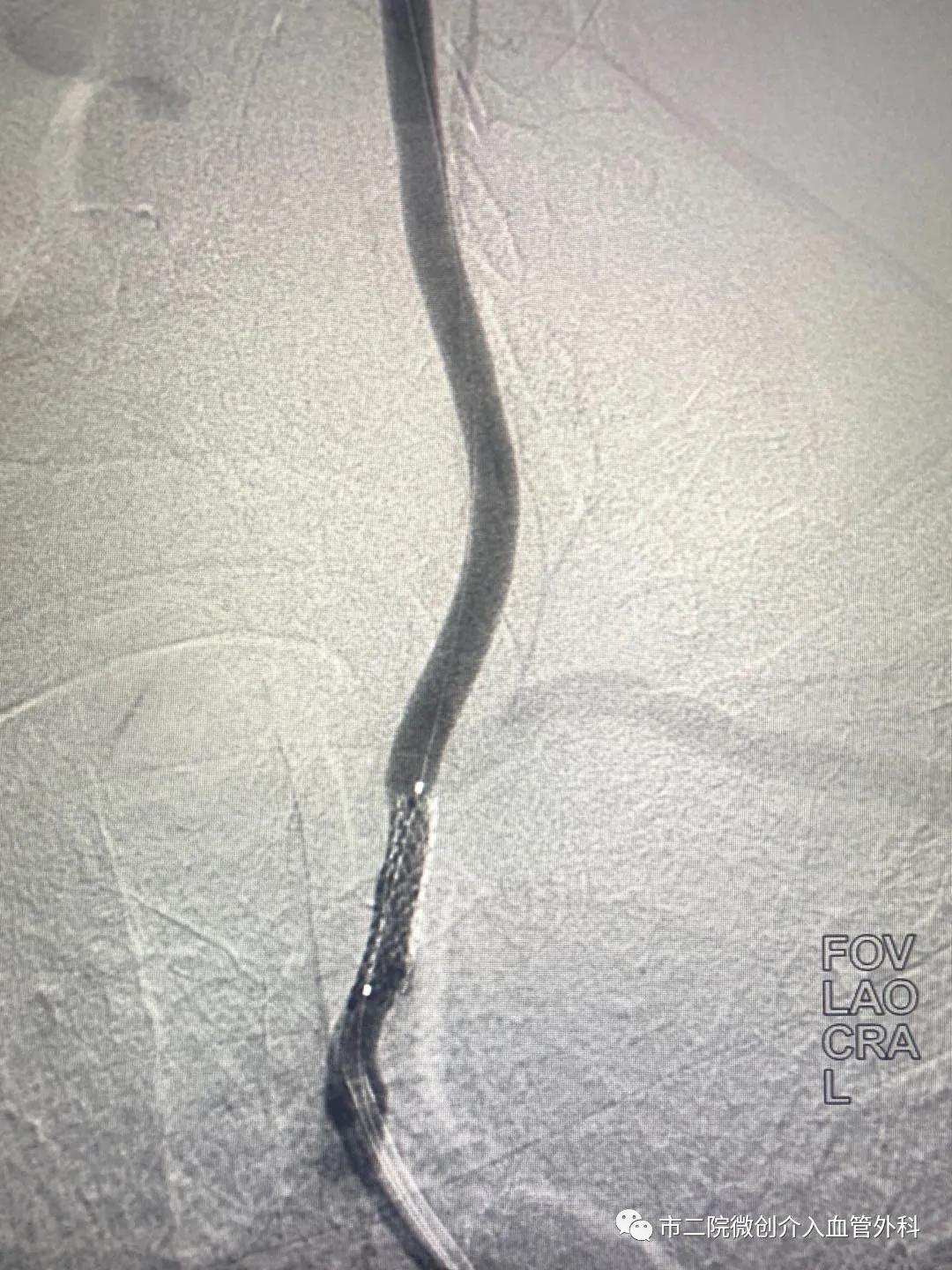 渭南二院血管外科专家,渭南市中心医院脑血管介入手术