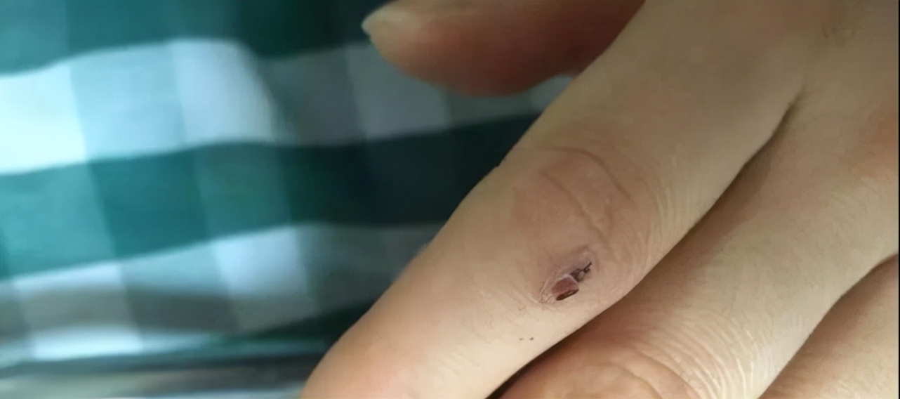 被蛇咬急寻抗蛇毒血清,专家被蛇咬伤抗蛇毒血清