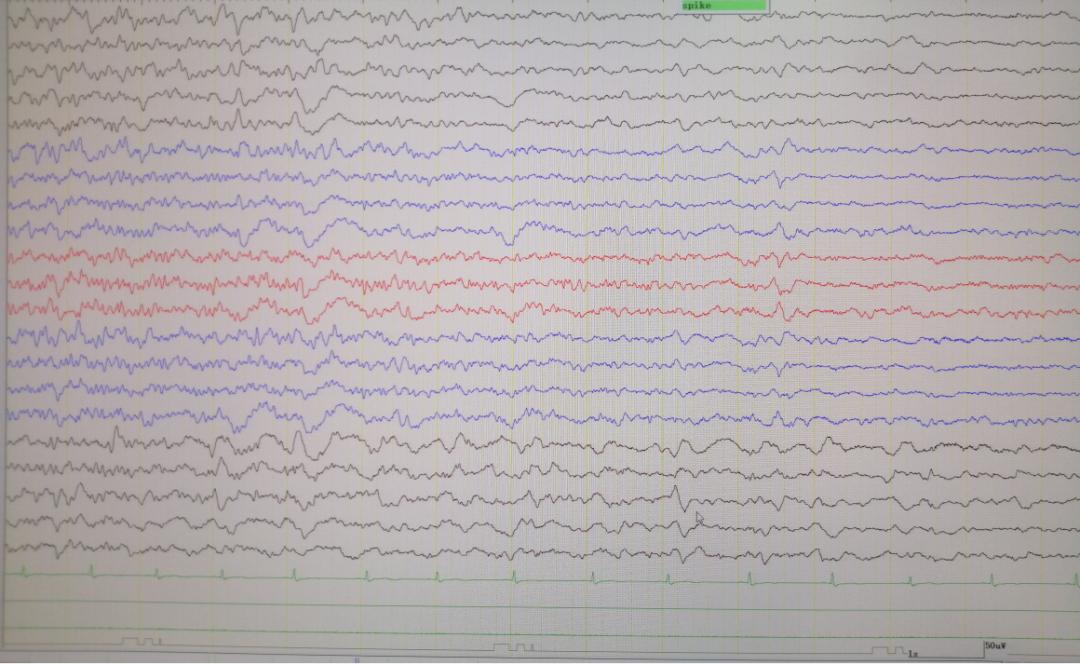 癫痫女性患者怀孕后换药影响大吗,癫痫病人怀孕可以停药不