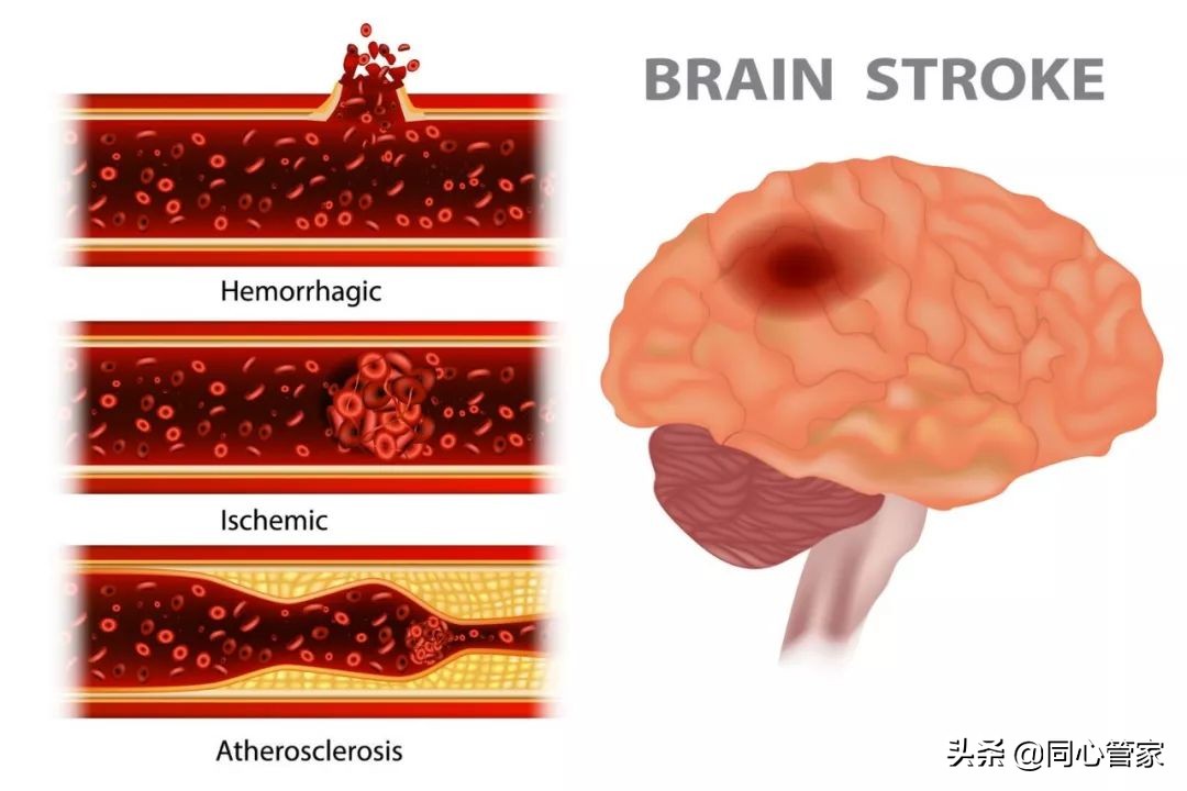 血管狭窄如何扼住生命的咽喉？让你全身器官都遭殃？