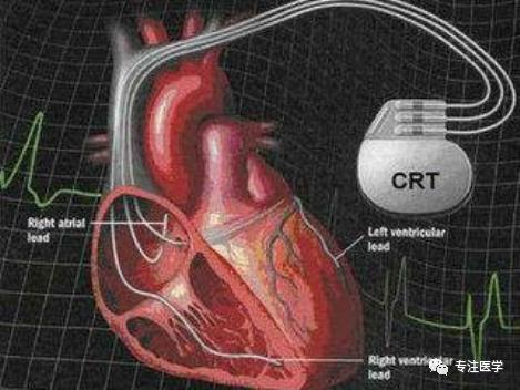 心脏再同步化治疗心力衰竭,心脏再同步化crt费用