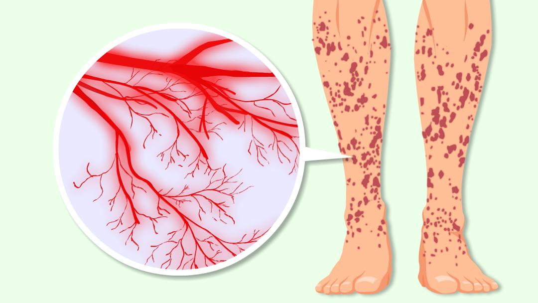 宝宝脚上腿上紫癜早上醒来就减轻,孩子腿上有红疹小心是过敏性紫癜