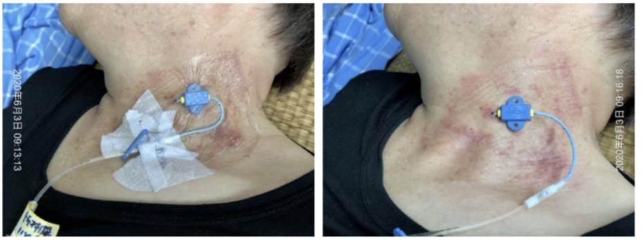 又见接触性皮炎？！不妨试试地塞米松+水胶体