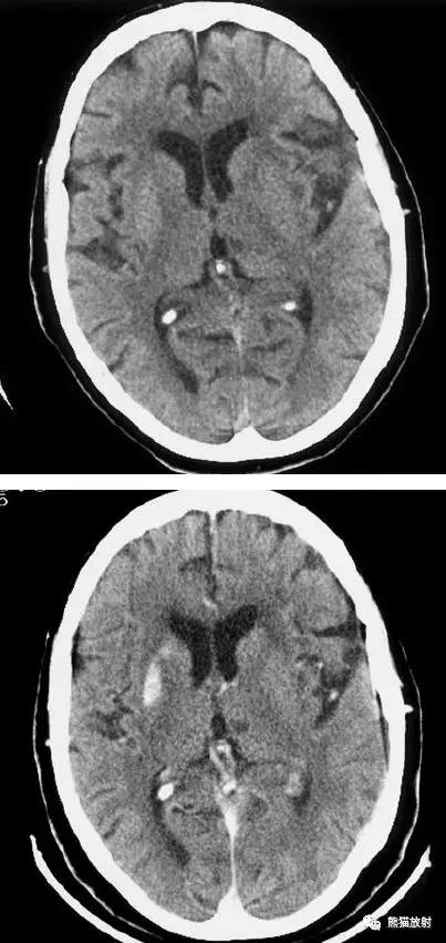 各部位脑梗死ct影像讲解,脑梗死ct影像最简单的是什么表现