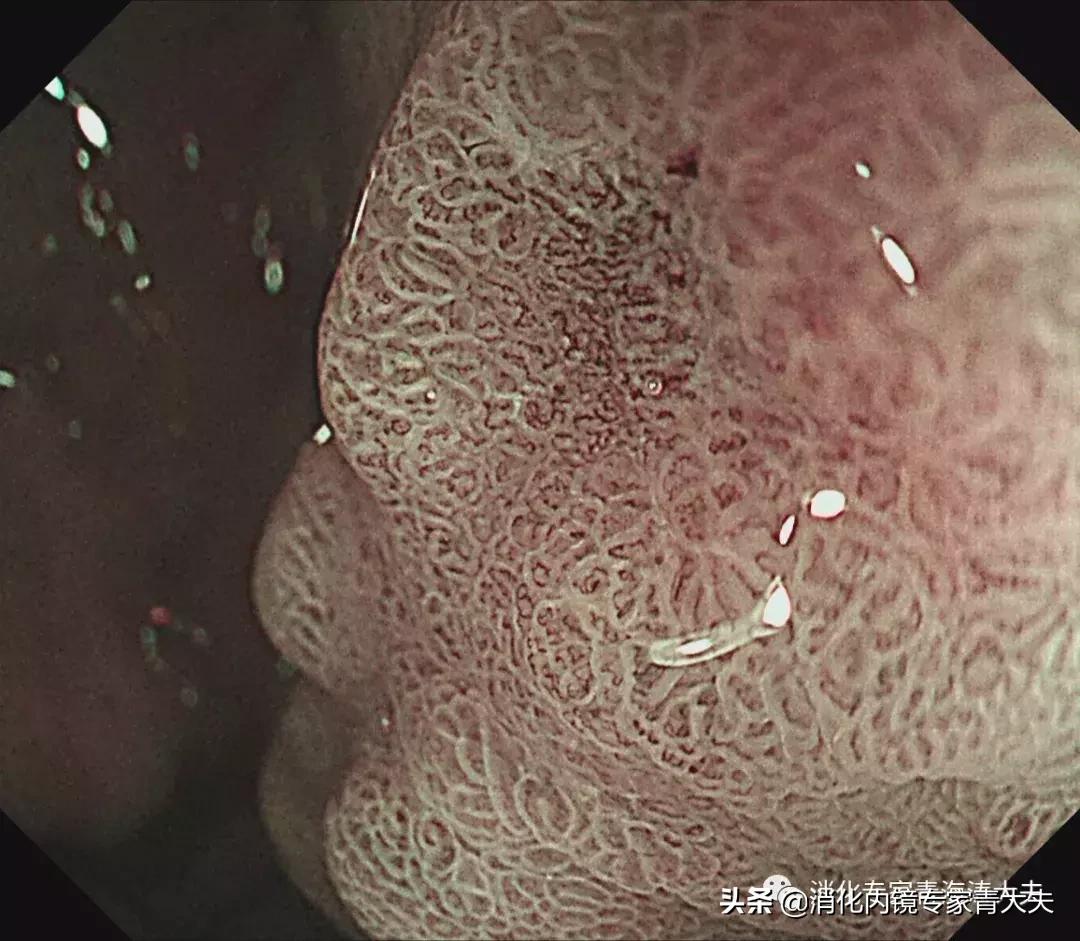 通过科普文章求治的一例胃窦后壁早癌