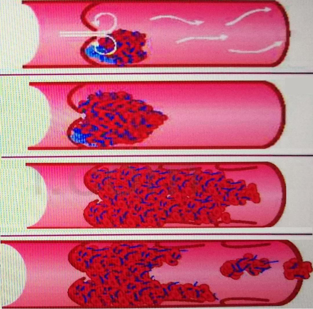 静脉血栓栓塞症发生的3个要素,静脉血栓十大抗凝误区