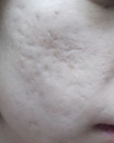 点阵激光能修复到什么程度,点阵激光凹陷疤痕能修复多少