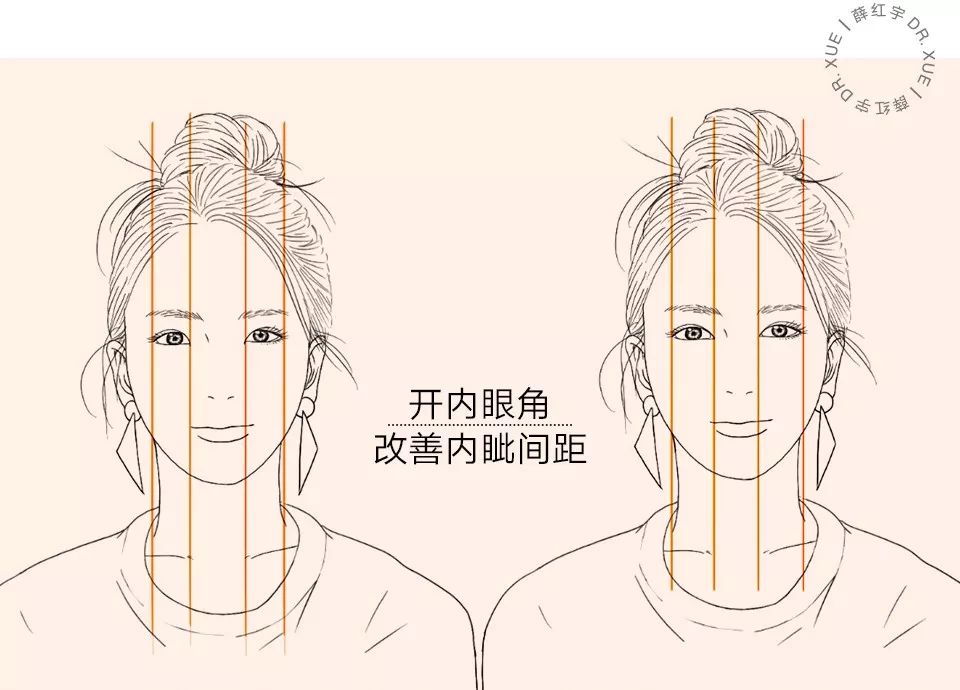 从美术角度谈眯眯眼,开内眼角传统术式
