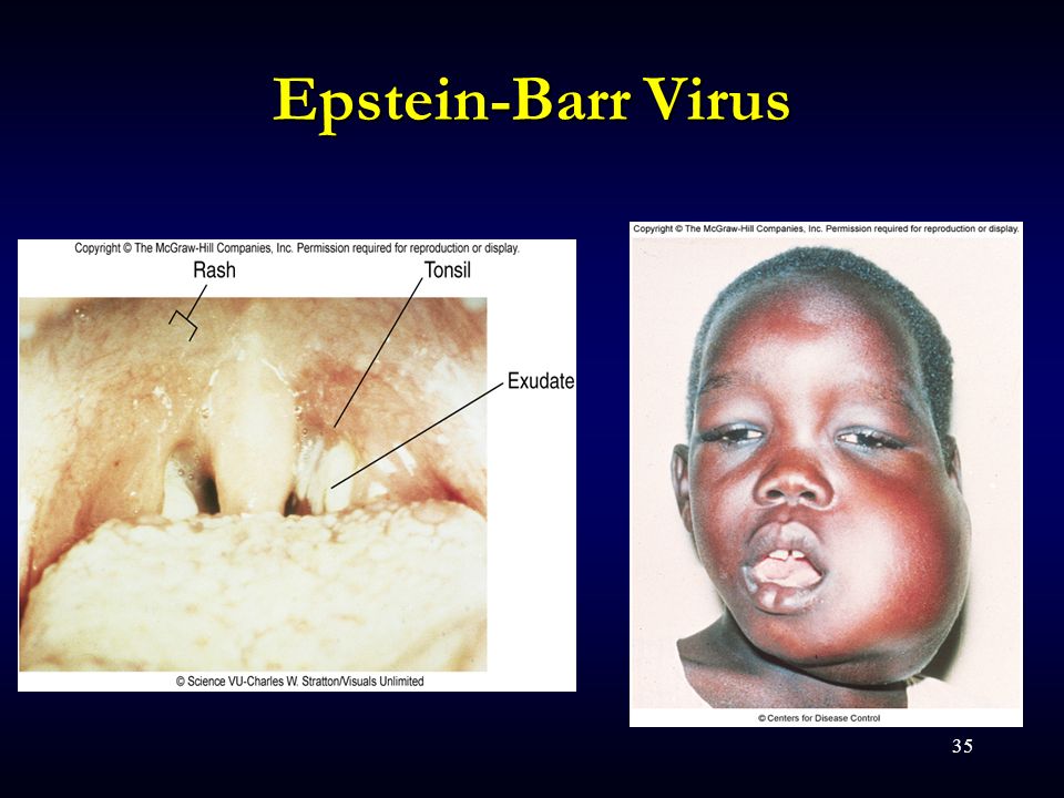 eb病毒感染是单核细胞增多吗,eb病毒感染症状有时候轻有时候重