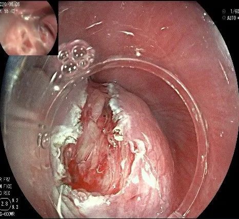 贲门处见隆起性病变,贲门高级别瘤变esd术后不能吃什么
