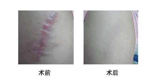 身上有长疤的人,身上有疤痕的人怎么样