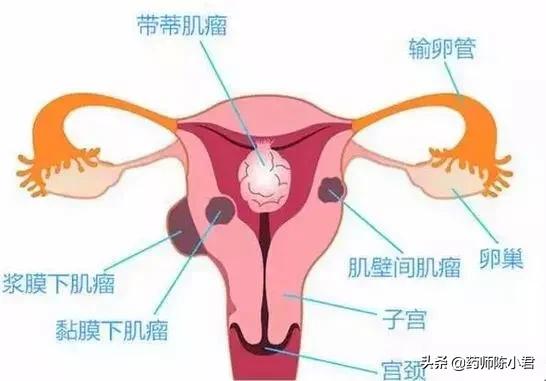 53岁张阿姨月经出血期特别长，腰酸，腹痛，医生说:子宫全切！