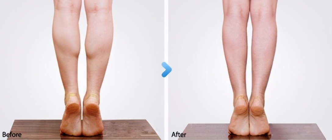 小腿粗壮如何变细腿不运动,小腿太瘦怎么办呢