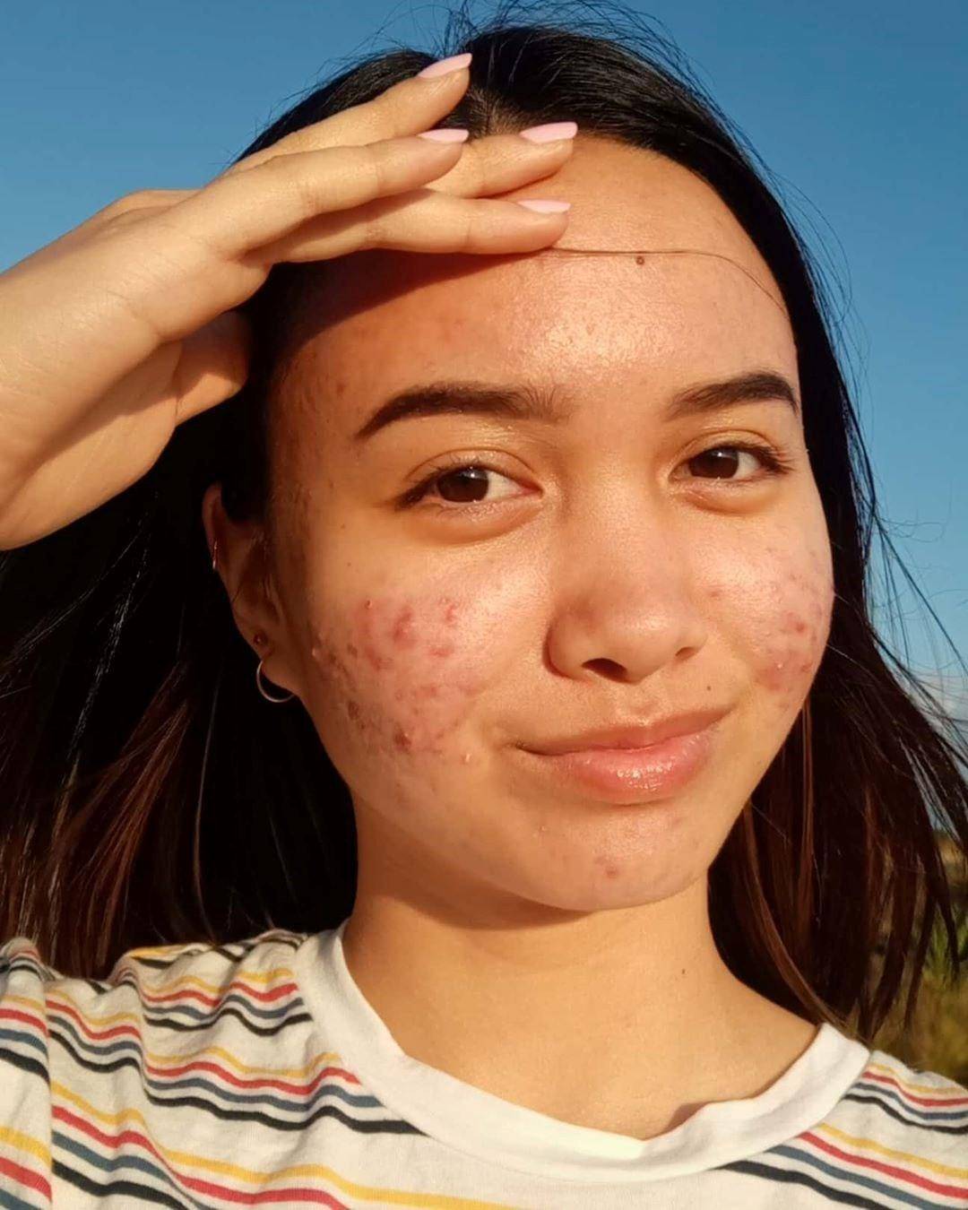 痘痘好多了脸一直红,痘痘反复没完没了