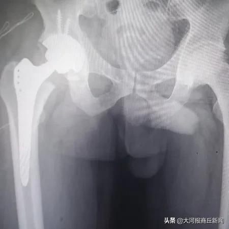 重塑健康!3小时4台关节置换圆满完成,柘城中医院再创新速度