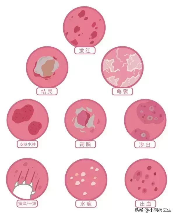 小强一样的皮疹——谈小儿湿疹