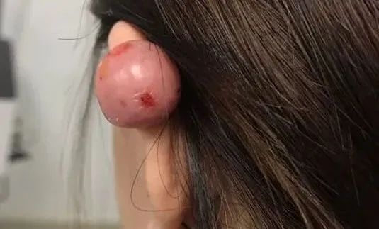 打耳洞打出个肉疙瘩,打耳洞长出肉疙瘩的概率多大