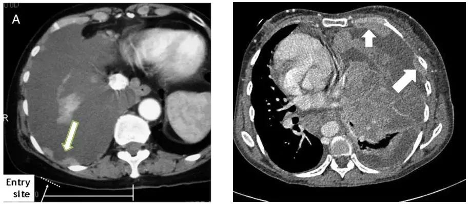 胸部超声引导下穿刺活检术流程,ct引导下肺穿刺活检优缺点