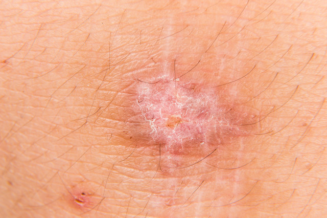 胸口疤痕疙瘩怎么能彻底消除,胸口长痘痘变成疤痕疙瘩怎么治