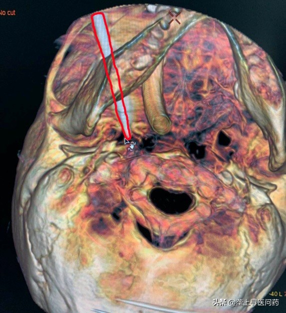 武汉市同济医院神经内科,武汉同济三叉神经手术