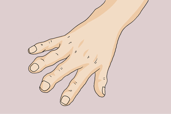 大骨节病是什么病,大骨节病的危害有哪些