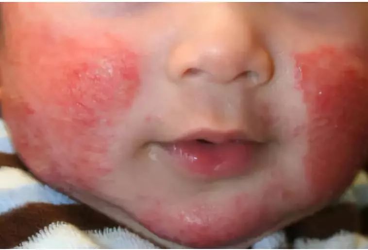 普及！宝宝湿疹不敢用药怕激素？湿疹护理指南来帮你