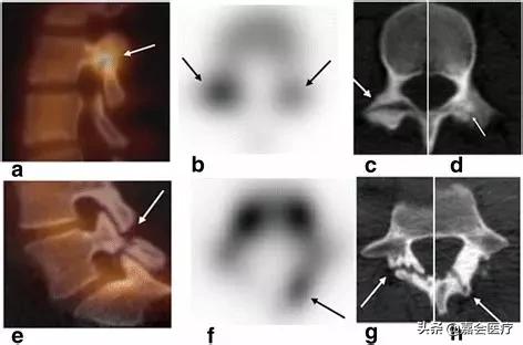 腰椎椎弓崩裂是什么原因造成的,腰痛是犯了什么因果