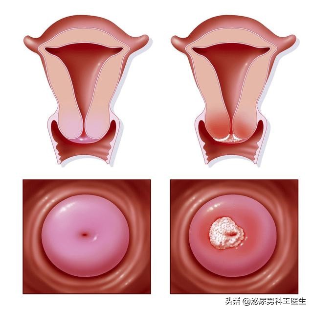 感染hpv病毒就一定会得宫颈癌吗,感染hpv容易宫颈息肉吗