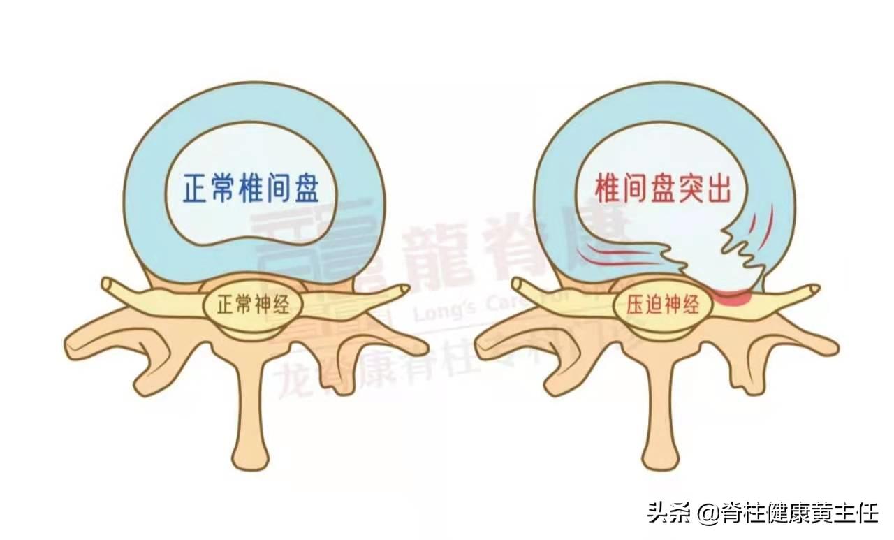 椎间盘突出介入治疗多长时间恢复,童国海介入法治疗腰椎间盘突出症