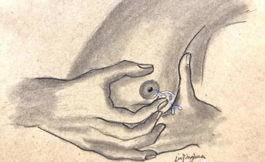 乳头溢液,是否得了乳腺疾病?市妇幼保健院乳腺外科姚医生解答