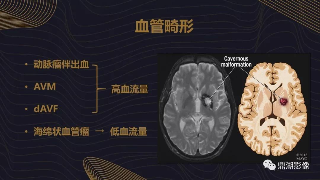 不简单|脑出血超详细学习笔记