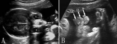 胎儿系统性超声检查有图像么,你需要知道的胎儿超声