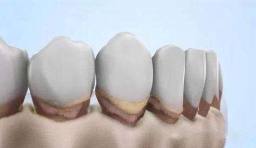 导致牙龈萎缩的4个原因,导致牙龈萎缩的4大原因