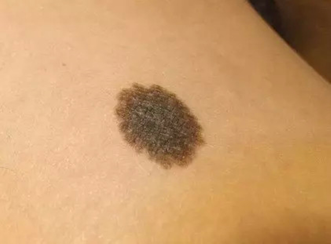 色素痣如何判断病变,色素痣怎么看出有癌变可能