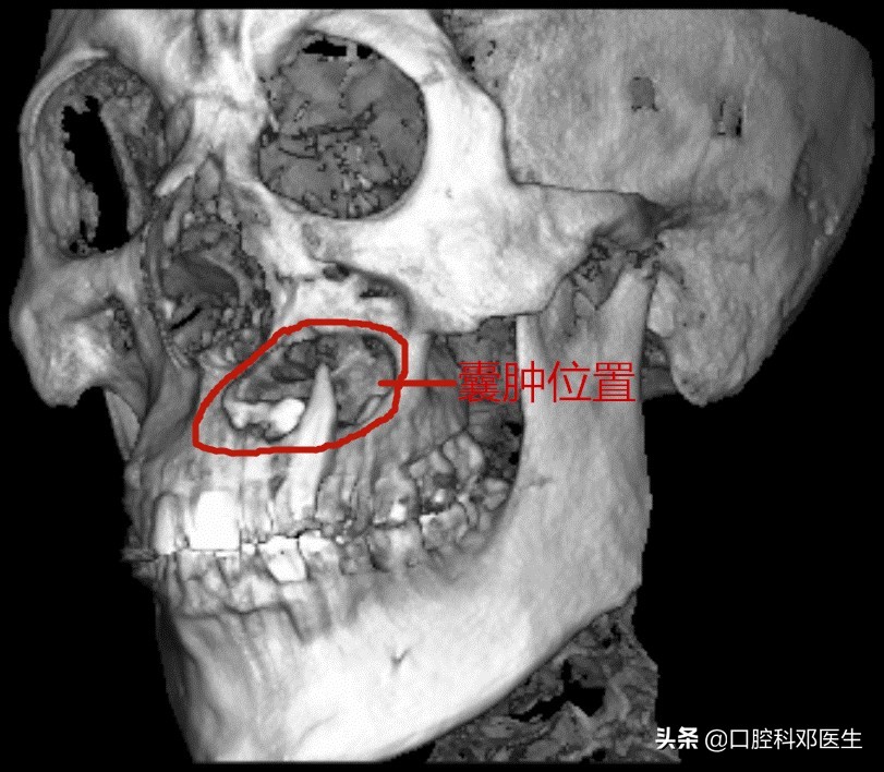 上颌左边埋伏阻生牙的拔除视频,埋伏阻生牙拔除会得干槽症吗