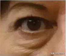 长期熬夜黑眼圈很重,长期熬夜导致的黑眼圈怎么办