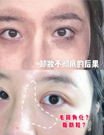 混油皮闭口卸妆油推荐,闭口敏感用什么卸妆油