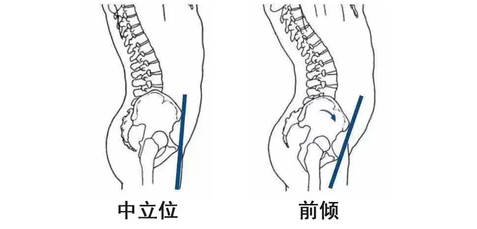 正美体态矫正骨盆旋转,正骨盆前倾如何矫正