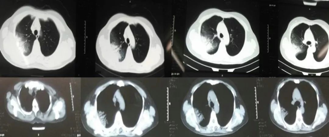 抗感染治疗后效果欠佳，感染非感染？TBLB和肺穿刺病理有哪些提示