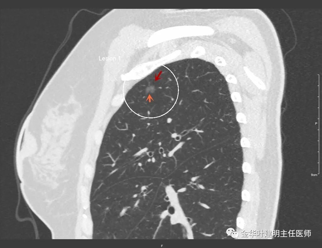 左肺上叶在ct影像上怎么看,平扫ct可以看出肺肿瘤的变化吗