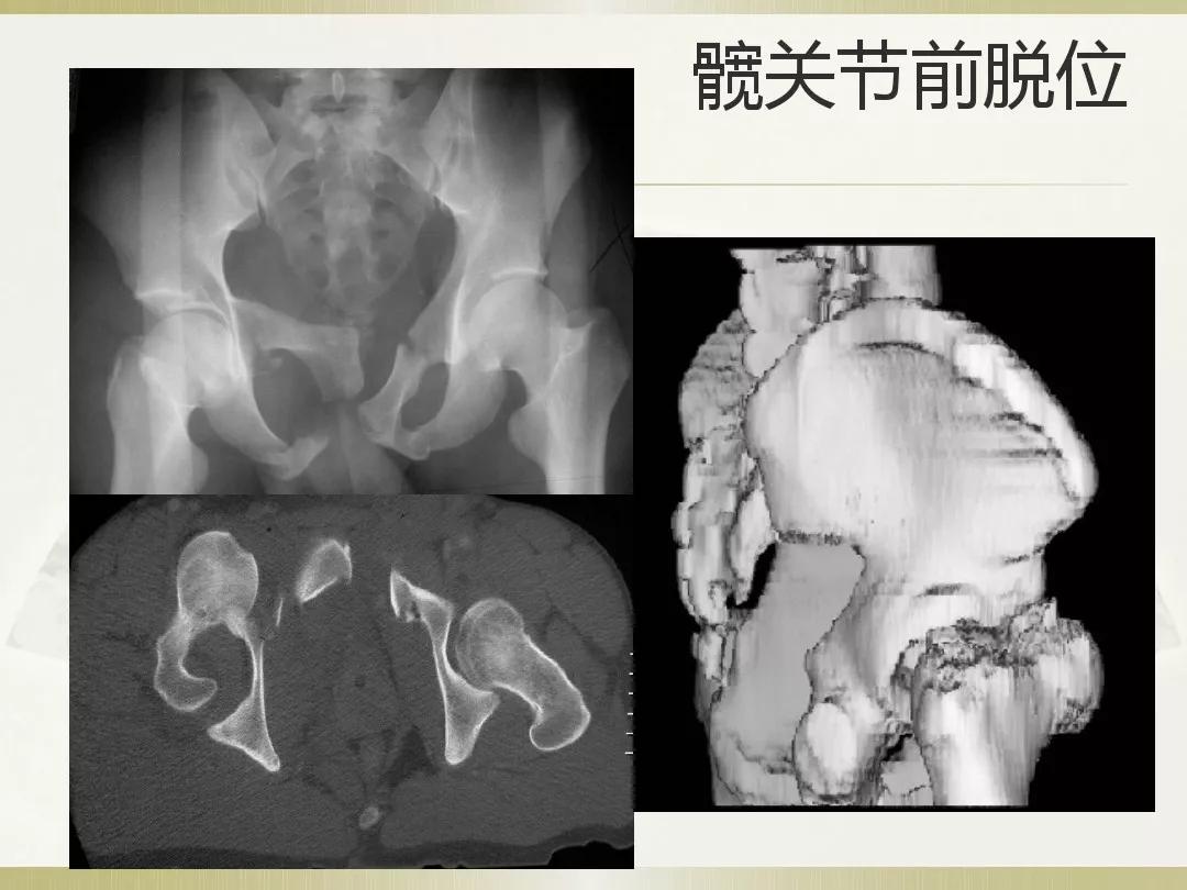 骨科x光片读片技巧,放射科骨科读片教程