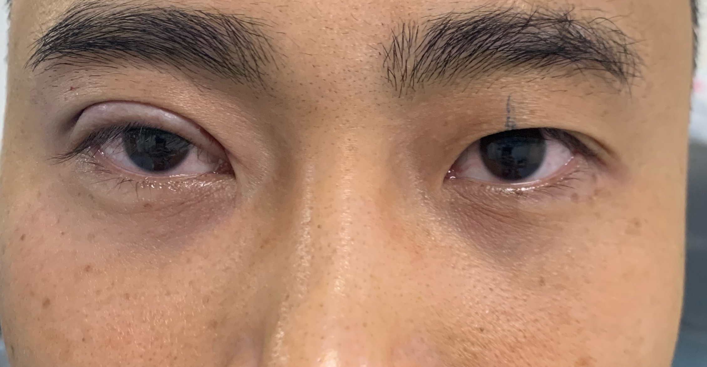 单眼皮怎么贴出平行双眼皮,单双眼皮现实中好看吗