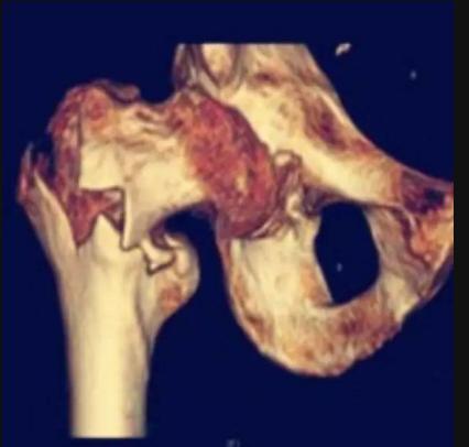 老年人骨折是什么骨折,老年人骨质疏松腰部骨折怎么办